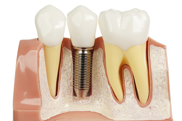 Dental Implants