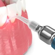 Advanced Surgical Treatment in Periodontology in Houston