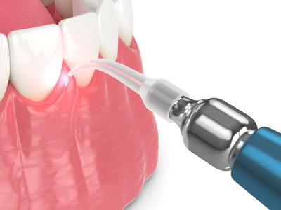 Advanced Surgical Treatment in Periodontology in Houston