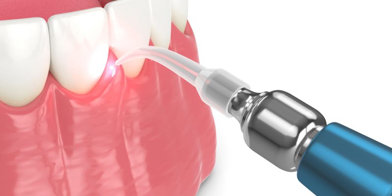 Advanced Surgical Treatment in Periodontology in Houston