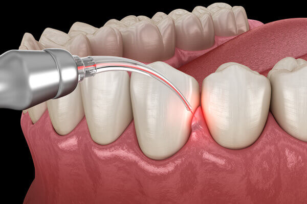 Advanced Surgical Treatment in Periodontology in Houston